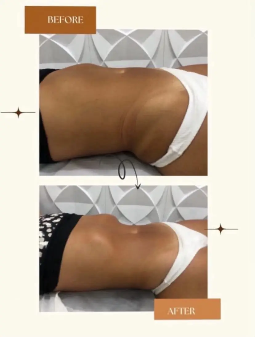 Antes e depois de contorno corporal na região do glúteo