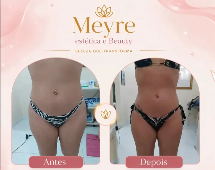 Antes e depois de tratamento corporal na região abdominal, com redução de medidas em abdômen e flancos