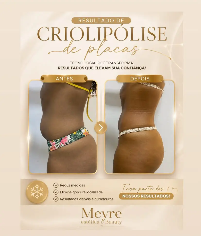Antes e depois de criolipólise de placas na região abdominal